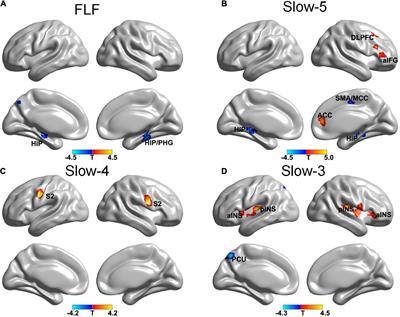 Acupuncture modulates the frequency-specific functional connectivity density in primary dysmenorrhea